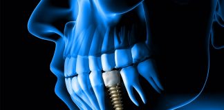 Dental Pulse Brăila – alege un implant dentar la standarde înalte